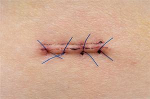 Comparing Mattress Sutures