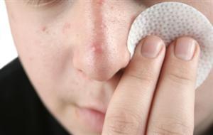 Acne Medication and Bacteria